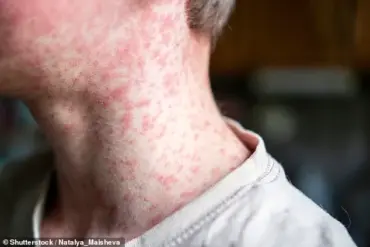 Urgent Warning: Measles Resurgence Looms as MMR Vaccination Rates Plummet Amid Child's Death in Liverpool – Experts Urge Immediate Action