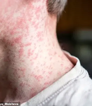 Urgent Warning: Measles Resurgence Looms as MMR Vaccination Rates Plummet Amid Child's Death in Liverpool – Experts Urge Immediate Action
