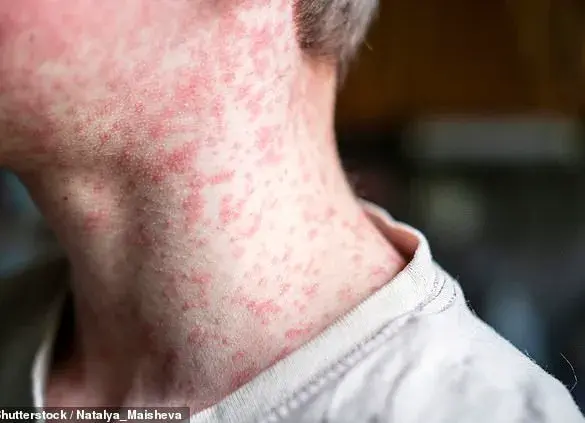 Urgent Warning: Measles Resurgence Looms as MMR Vaccination Rates Plummet Amid Child's Death in Liverpool – Experts Urge Immediate Action