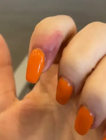 Woman Files Lawsuit Against Portland Nail Salon, Alleging Herpes Infection from Manicure
