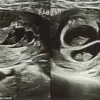 A Rare Medical Marvel: The Unprecedented Journey of a Mother Expecting Quintuplets and Its Community Impact