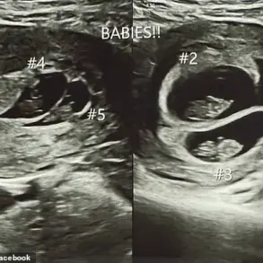 A Rare Medical Marvel: The Unprecedented Journey of a Mother Expecting Quintuplets and Its Community Impact