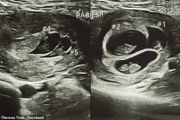 A Rare Medical Marvel: The Unprecedented Journey of a Mother Expecting Quintuplets and Its Community Impact