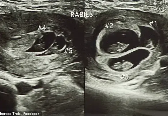 A Rare Medical Marvel: The Unprecedented Journey of a Mother Expecting Quintuplets and Its Community Impact