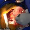 Behind Closed Doors: First Pig Lung Transplant into Human Highlights Limited Access to Xenotransplantation Milestone