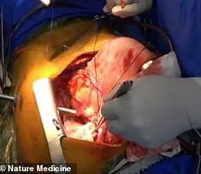 Behind Closed Doors: First Pig Lung Transplant into Human Highlights Limited Access to Xenotransplantation Milestone