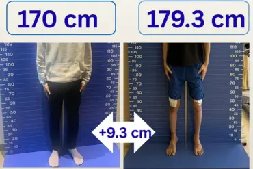 Height Hopes Drive UK Men to Costly, Painful Surgery