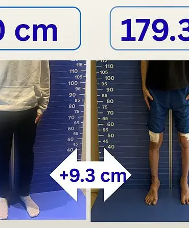 Height Hopes Drive UK Men to Costly, Painful Surgery