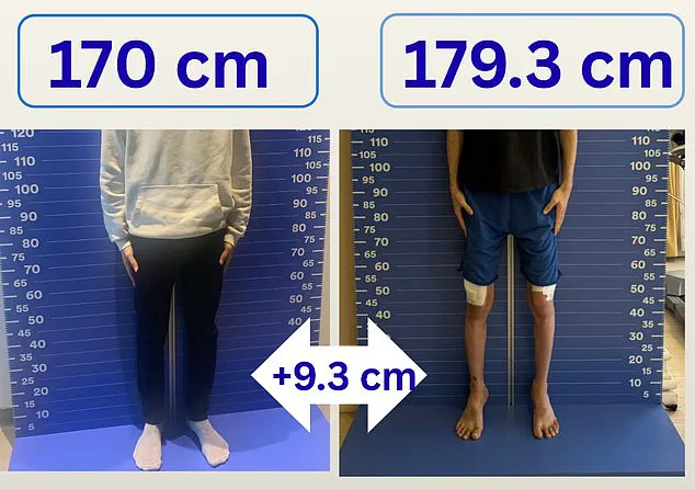 Height Hopes Drive UK Men to Costly, Painful Surgery