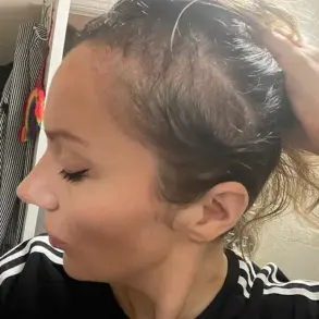 The Sun's Embrace: A Lifeline for Defiance Against Hair Loss