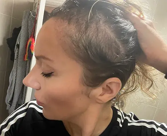 The Sun's Embrace: A Lifeline for Defiance Against Hair Loss