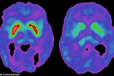 Breakthrough Discovery Links Common Virus to Parkinson’s Disease, Reshaping Understanding of Neurological Condition