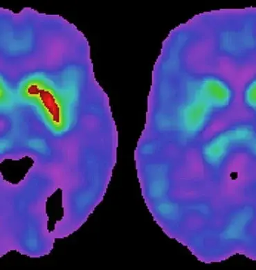 Breakthrough Discovery Links Common Virus to Parkinson’s Disease, Reshaping Understanding of Neurological Condition