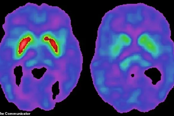 Breakthrough Discovery Links Common Virus to Parkinson’s Disease, Reshaping Understanding of Neurological Condition