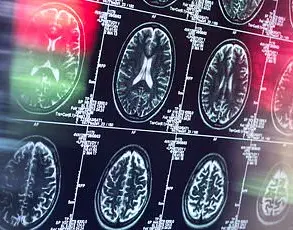Late-Breaking Discovery: Johns Hopkins Reveals Early Dementia Prediction via Novel Brain Imaging Technique