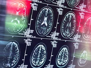 Late-Breaking Discovery: Johns Hopkins Reveals Early Dementia Prediction via Novel Brain Imaging Technique